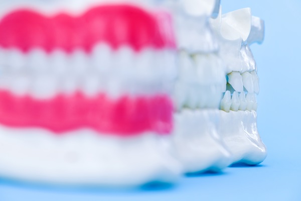 Dental Crowns To Preserve Your Tooth Following A Root Canal