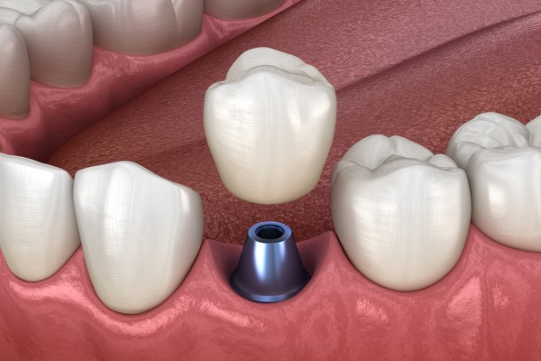 What To Do If An Implant Crown Falls Out Smiles By Julia Fort 